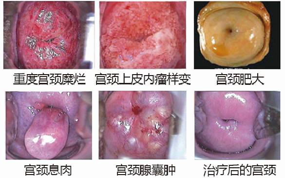 宫颈糜烂最新治疗方法概述